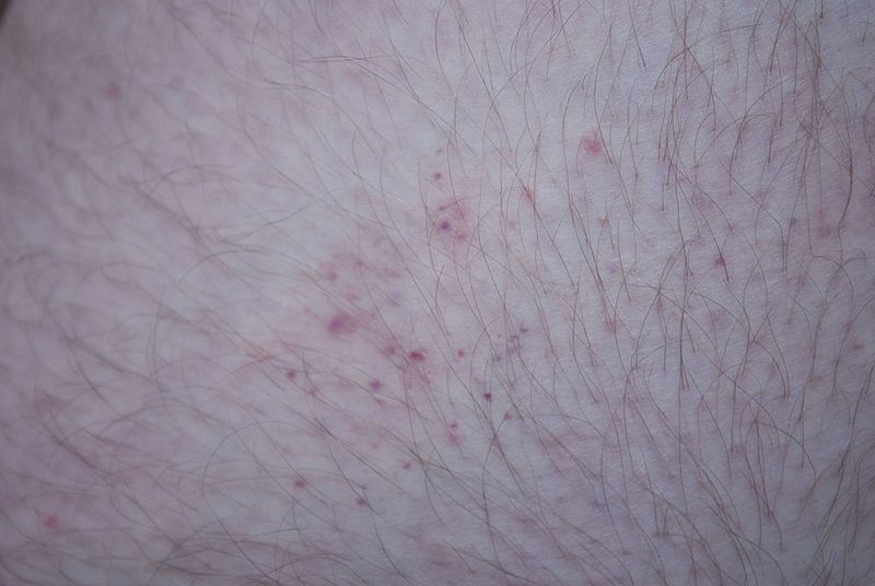 bed bug bites on humans. Pictures Of Bed Bug Bites On